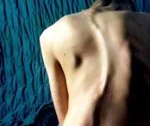 Сколиоз и его последствия