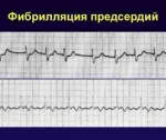 Фибрилляция предсердий: признаки, осложнения, диагностика