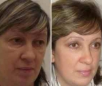 Особенности блефаропластики