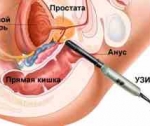 Для чего делается ТрУЗИ предстательной железы