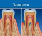 Что такое пародонтоз